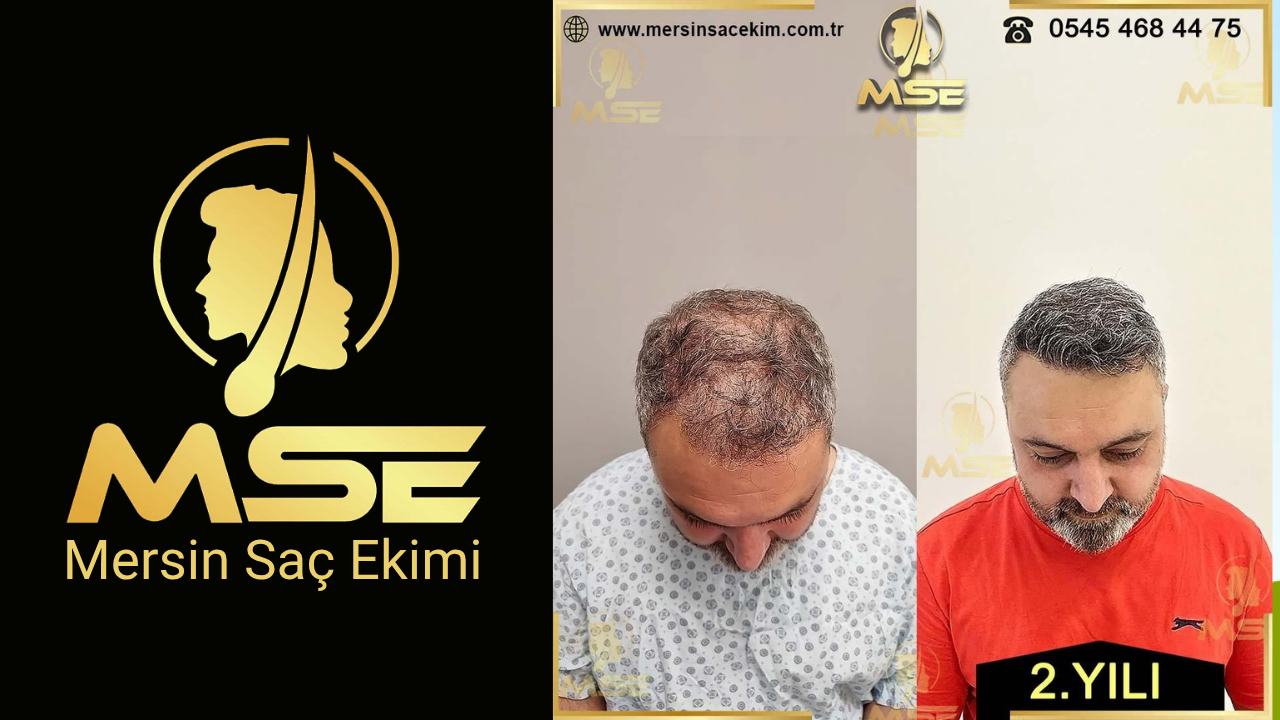 MERSİN SAÇ EKİMİ